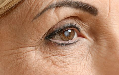 Close up of eye with cataracts