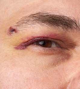 Close up of eye injury
