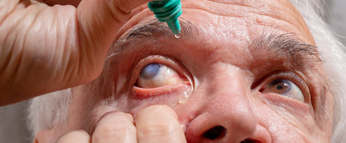 Man using eye drops on eye with cataracts