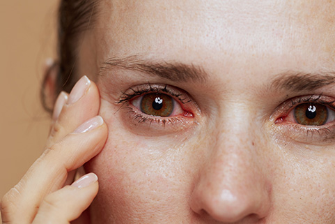 Woman with red eye<br />
